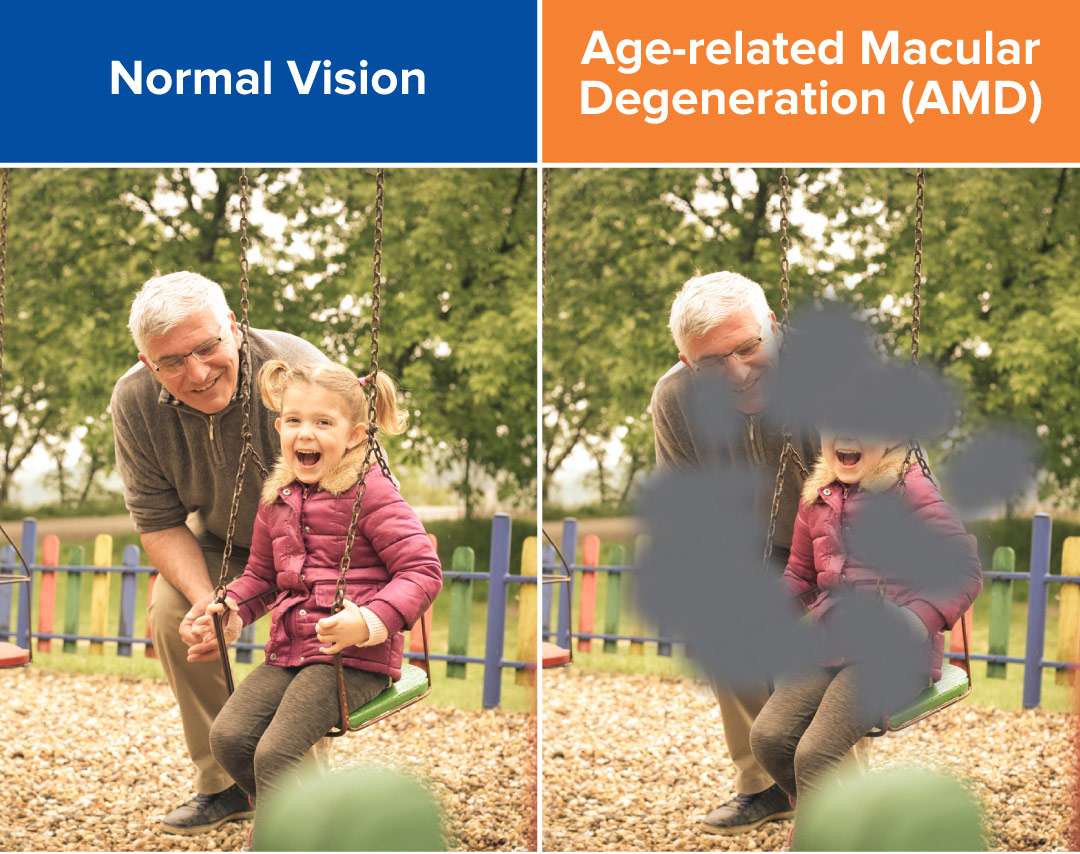 Age-related Macular Degeneration