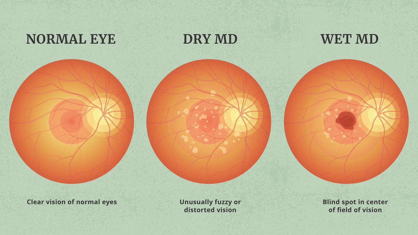 DRY vs WET AMD