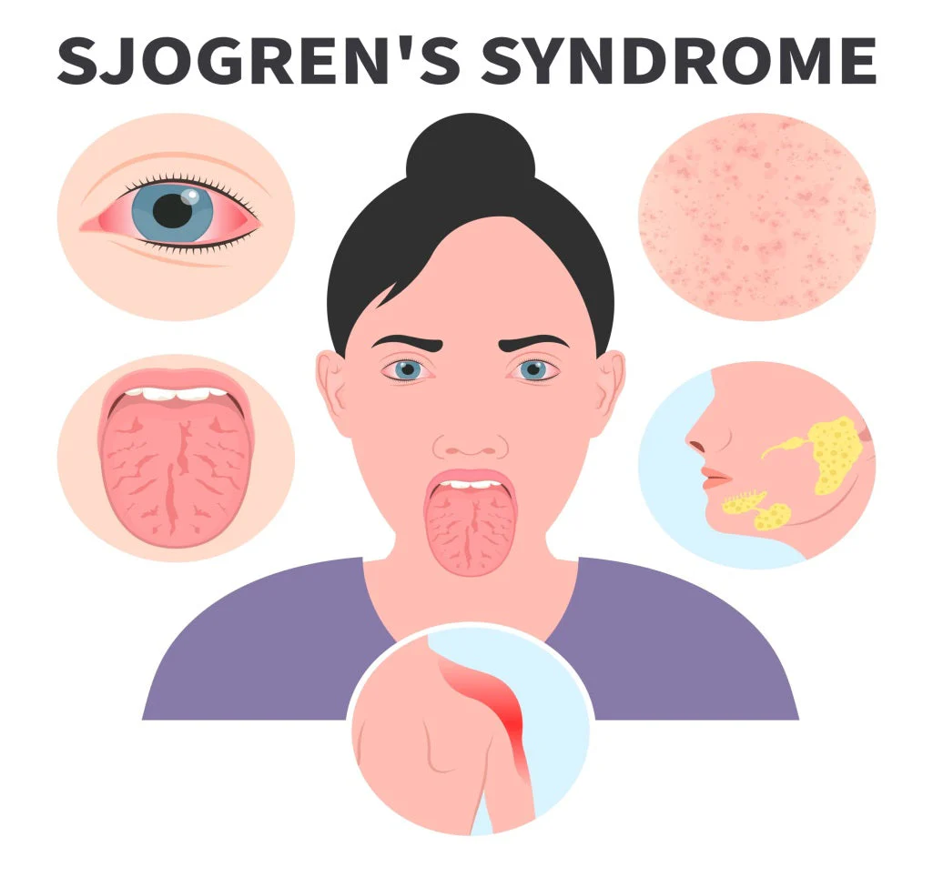 Sjogren's syndrome