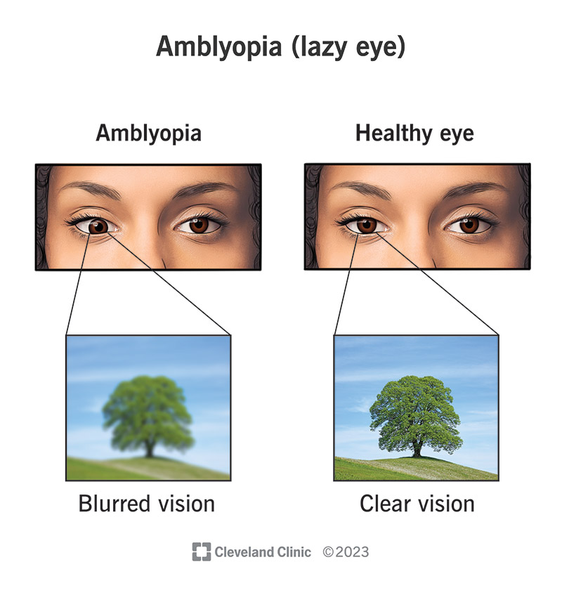 Amblyopia